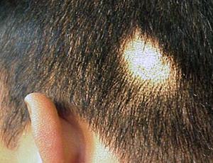 Hair Growth Products for Bald Spots | Hair Transplant Dubai