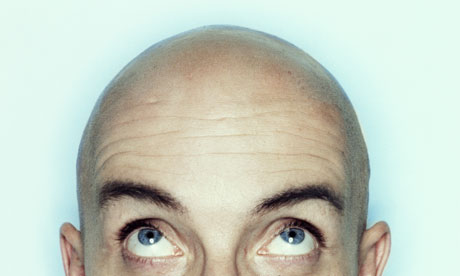 Frontal Baldness