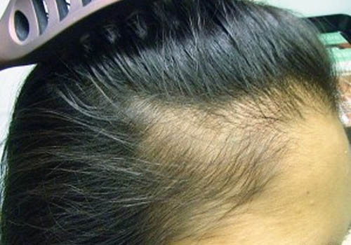 Scalp Infections That Cause Hair Loss