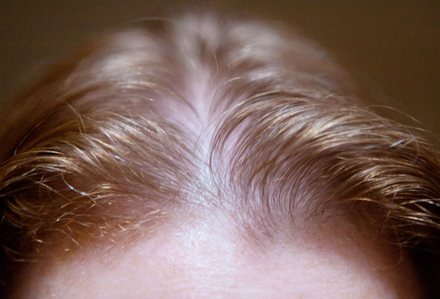 How to Repair Crown Hair Thinning