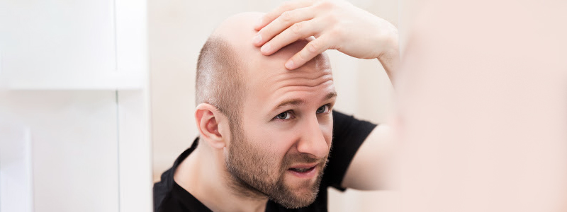 5 Effective Home Remedies for Baldness