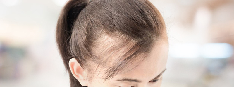 Treatment for Female Thinning Hair