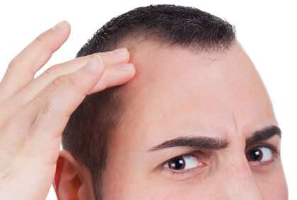 Baldness Along the Frontal Hairline