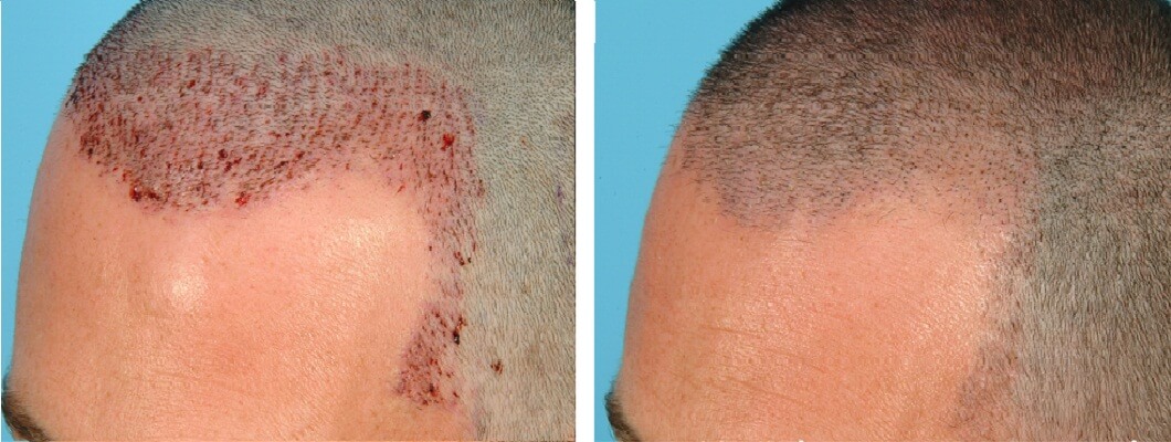 How To Clean And Remove Scab After Hair Transplant Surgery ...