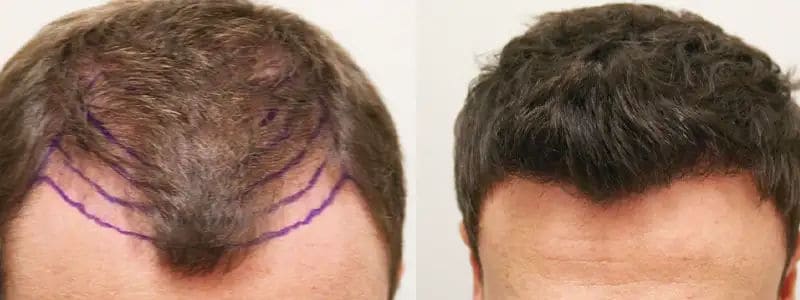 Minoxidil after hair transplant
