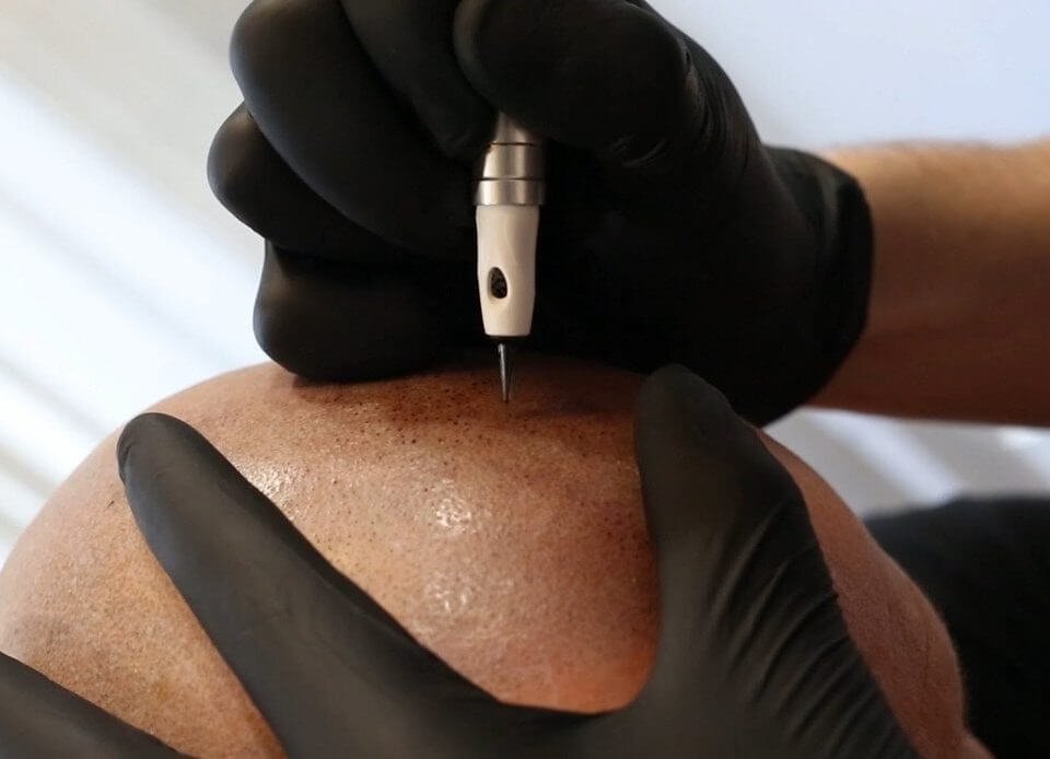 scalp micropigmentation