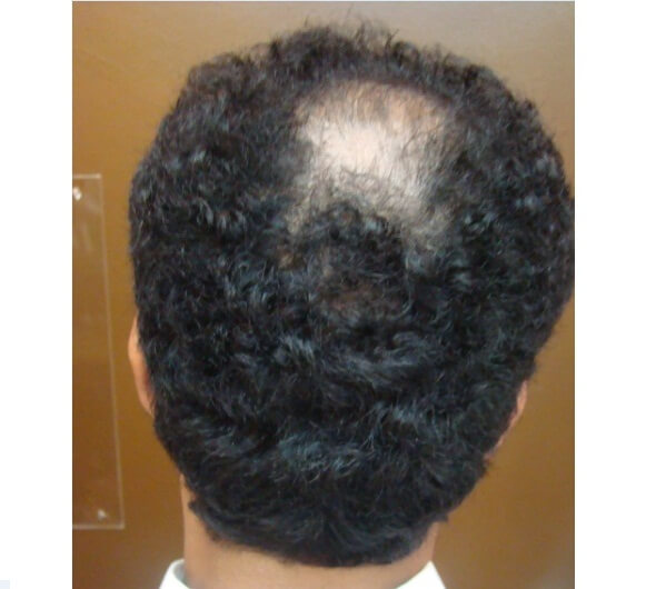 Diffuse Patterned Alopecia