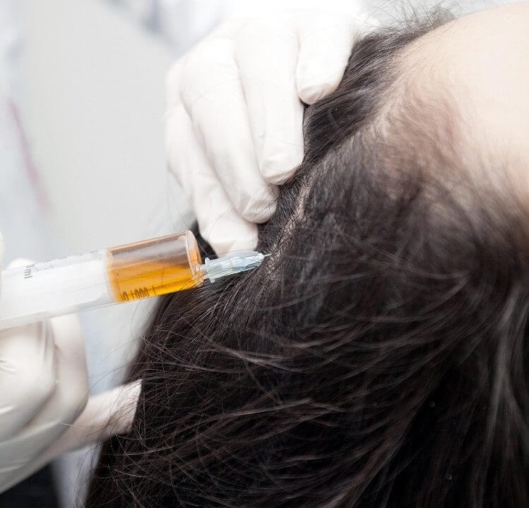 mesotherapy for hair loss treatment