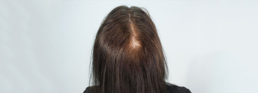 women-hair-transplant