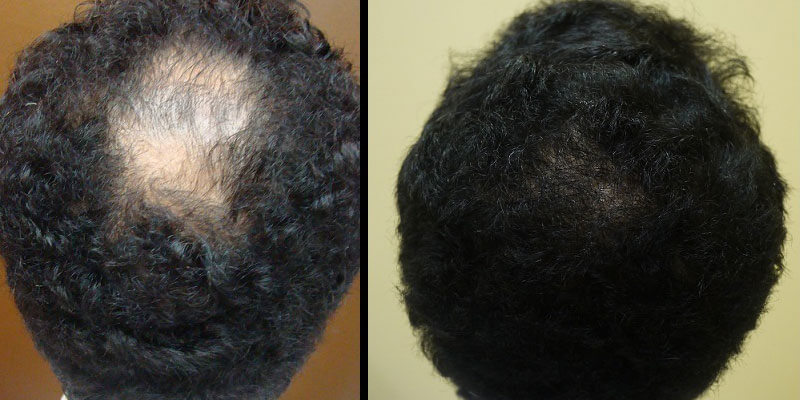 Hair transplant before and after