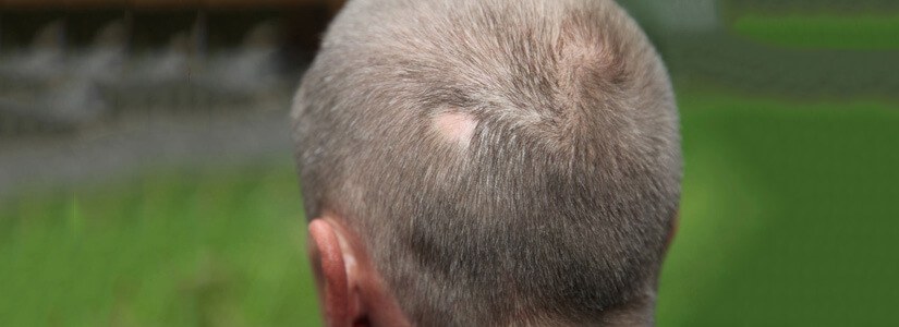 alopecia treatment in dubai