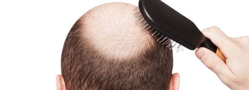 Six things you need to do NOW to prevent hair loss | Hair Transplant Dubai