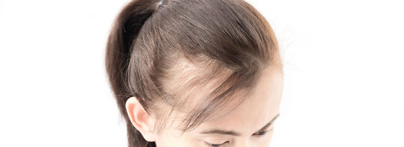 Sudden hair loss: How can it be treated? | Hair Transplant Dubai