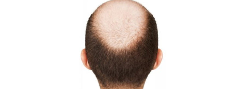 male-pattern-baldness