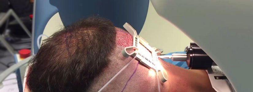 robotic-hair-transplant