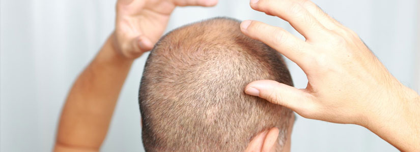cictrical-alopecia