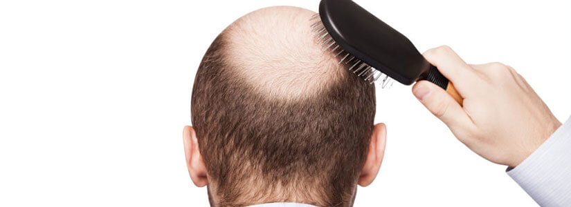 Involutional Alopecia vs. Androgenic Alopecia in Dubai