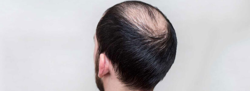 alopecia areata treatment in dubai