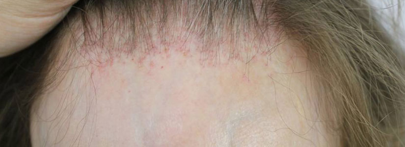 scarring-alopecia