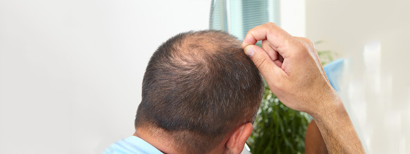 Ultimate Guide To Alopecia Treatment | Hair Transplant Dubai