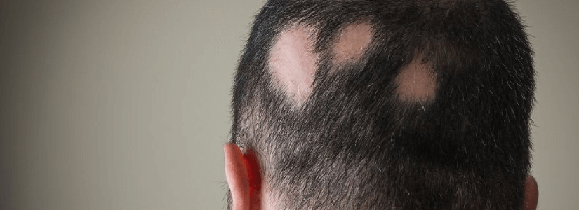 Alopecia Areata What are your options