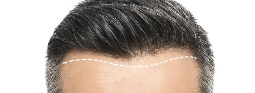 How Many Grafts Do I need for a Good looking Hair Transplant?