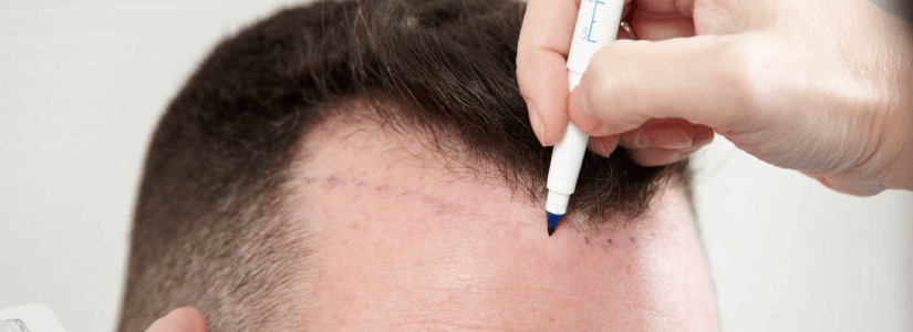 Should you have a hair transplant in the crown? | Feller & Bloxham Medical