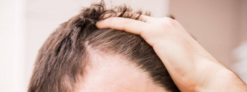 10 Simple things you can do to fight hair loss