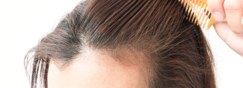 Female pattern hair loss (FPHL)