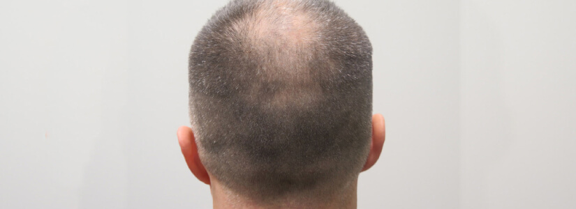 Should I expect to lose my native hair immediately after a hair transplant