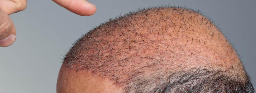 The Facts about Shock Loss Following Hair Restoration Surgery