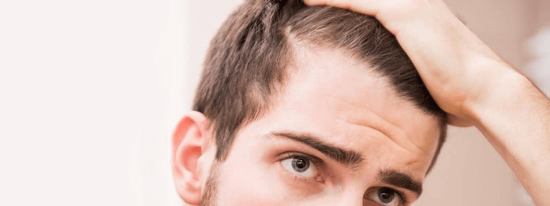 How Do I Tell If My Hairline Is Receding? 