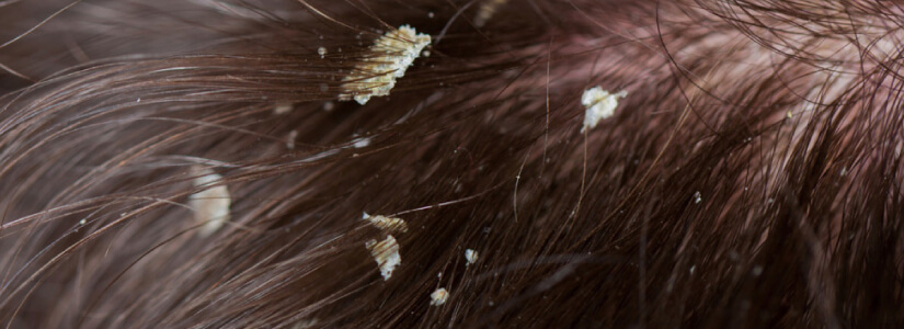 How eczema on your scalp could lead to hair loss
