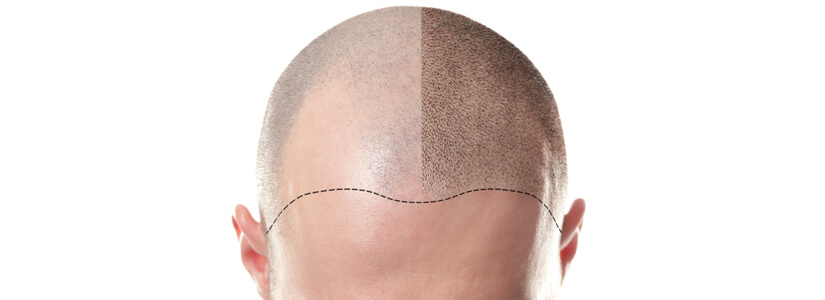 Scarring from a hair transplant