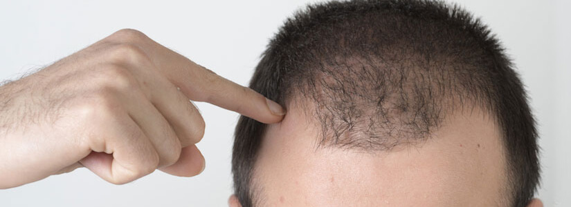Reasons for Hair loss in men under 25