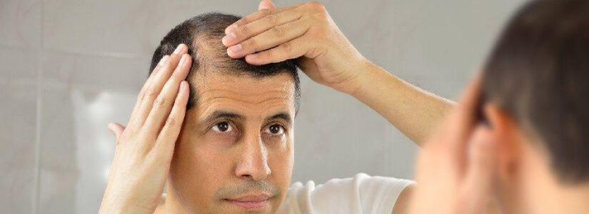 Early Signs That Indicate You Are Going Bald