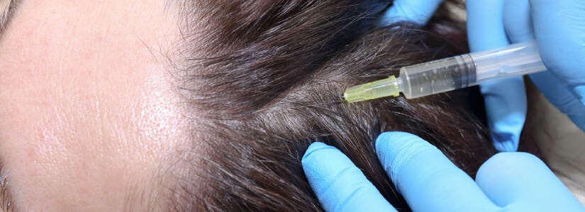 Can Blood Plasma Injections treat hair loss and baldness