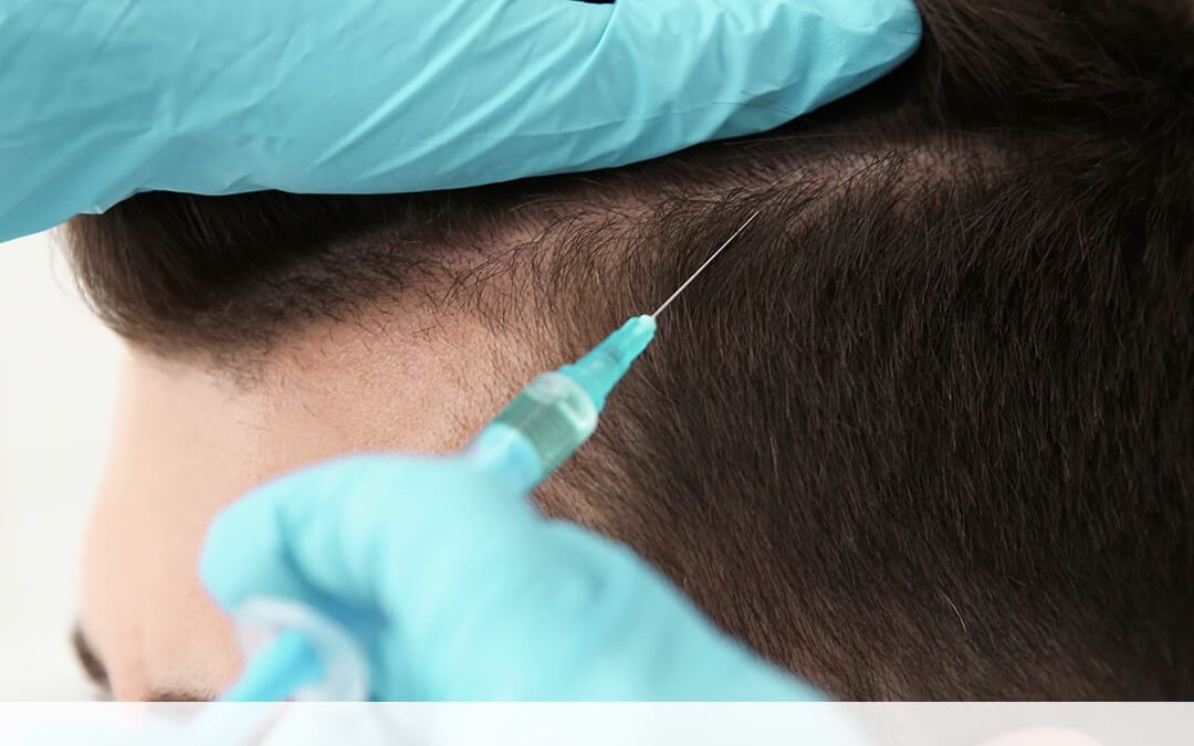 PRP treatment for hair loss in dubai