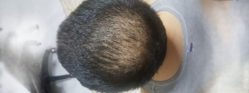 How Long After Hair Transplant Will Grafts be Secure?