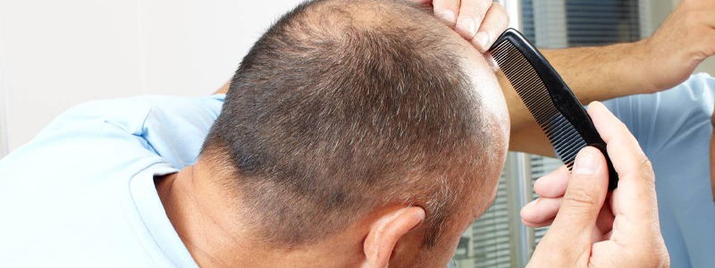 What Are the Best Vitamins for Hair Loss?