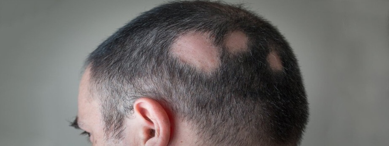 How Long Does it take for Alopecia Treatment to fully Cure