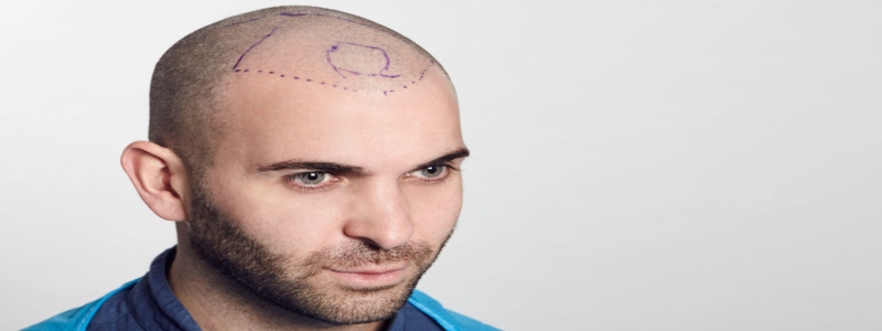 Choosing a Hair Transplant Surgeon Here is what to check