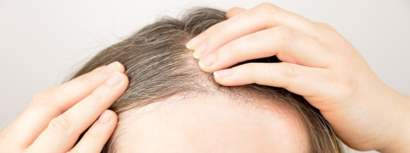 Why doctors recommend hair transplant for female hairline
