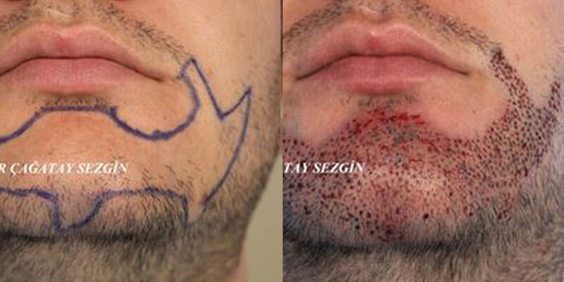 Beard transplant before after image