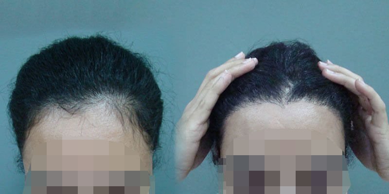 Hair transplant before and after image