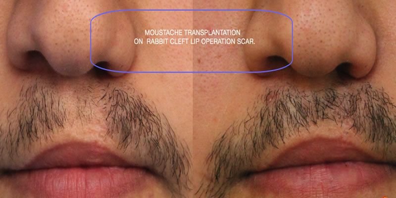 Beard-Hair-Transplant-Before-and-After