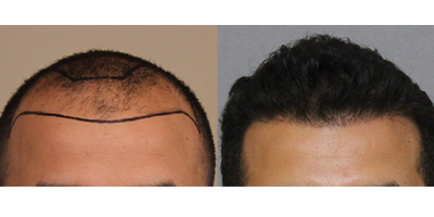 Hair Transplant Before and after