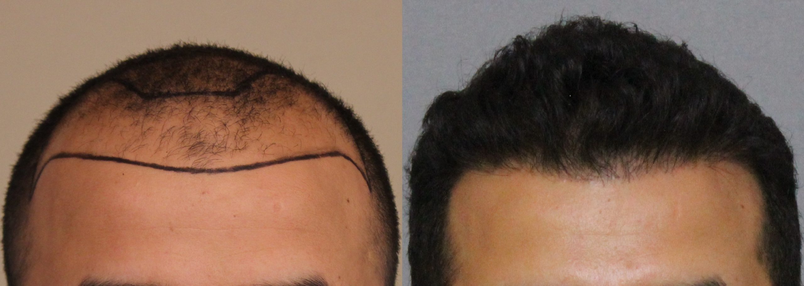 Hair transplant Before & After