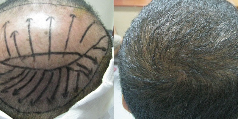 Hair transplant Before and after image