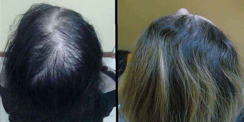Hair transplant before after image